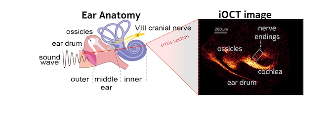 iOCT graphic